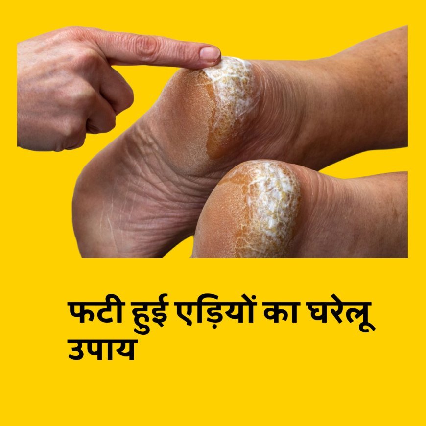 एड़ियों के फटने से होती है परेशानी तो जानिए आसान उपाय